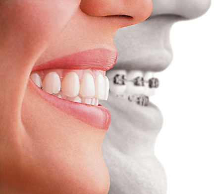 i00035_invisalign1