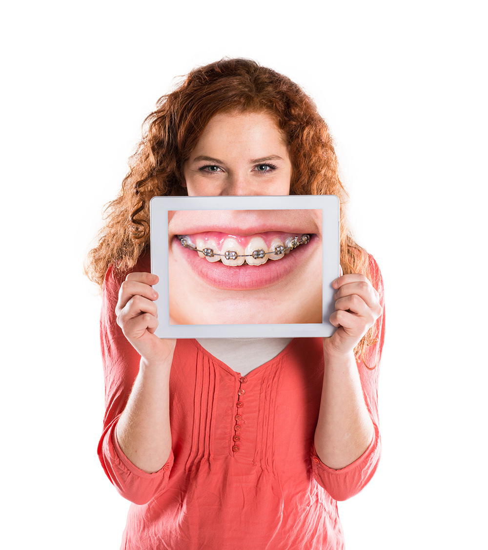Getting The Invisalign Teen System 26