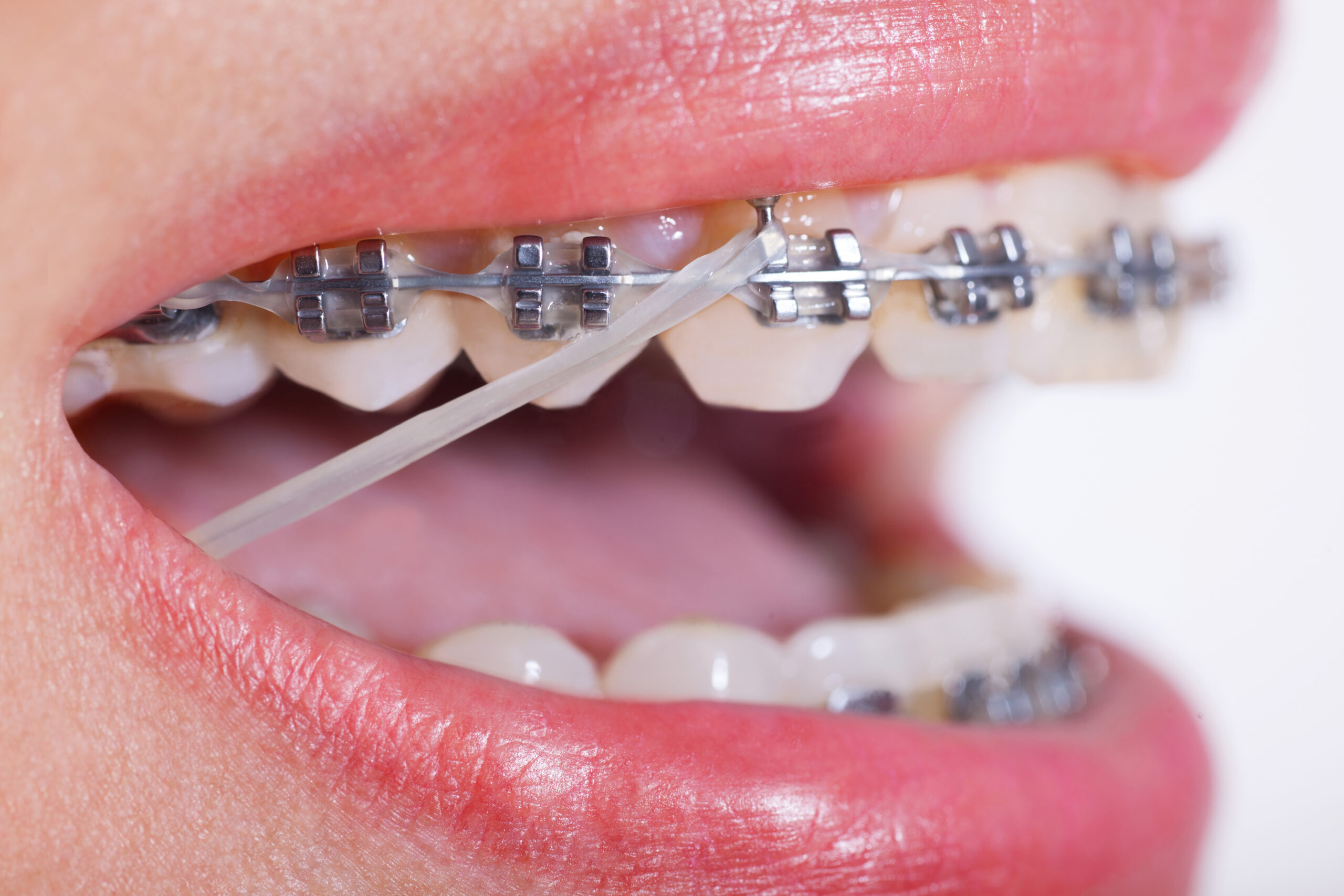 Cheap Orthodontist in North Canberra