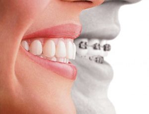 Invisalign criteria