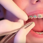 colored braces