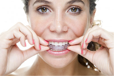Invisalign Treatment Step 2 Invisalign Treatment Step 2