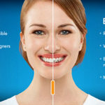 Invisalign Teen vs Braces