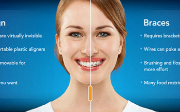 Invisalign Teen vs Braces