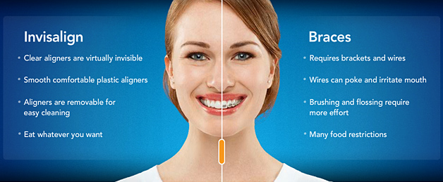 Invisalign Vs Braces Chart