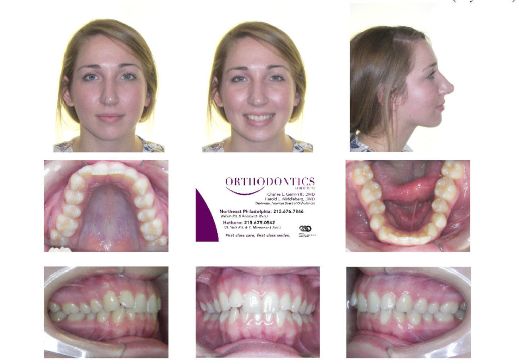 Invisalign Before and After Invisalign Reviews Philadelphia