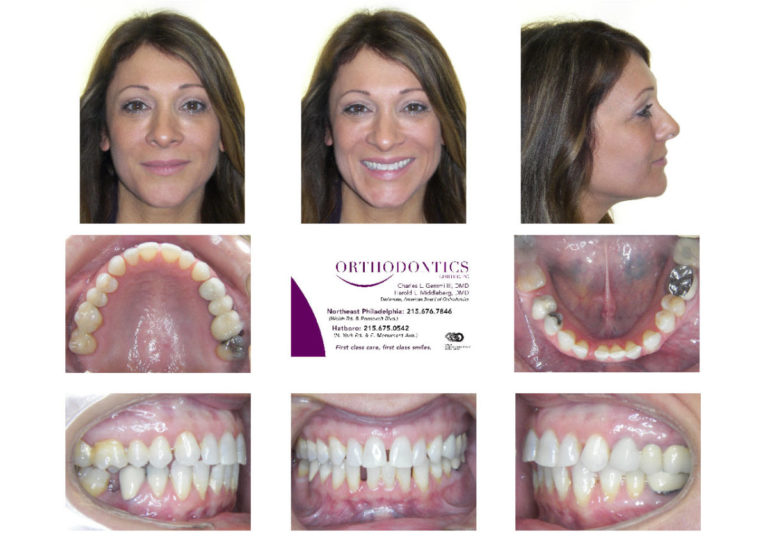 Invisalign Before and After Invisalign Reviews Philadelphia