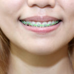 keeping braces clean