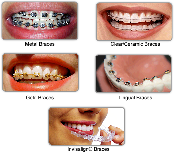 https://www.orthodonticslimited.com/wp-content/uploads/2014/10/Different-types-of-braces.png
