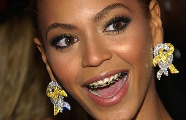 Beyonce Braces