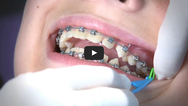 Braces Elastics Care