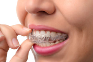 speed up invisalign