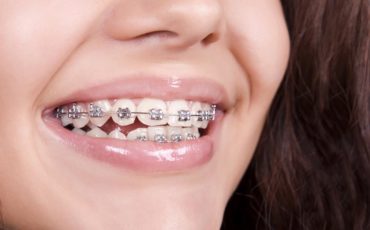 5 Facts About Rubber Bands for Braces That You Must Know