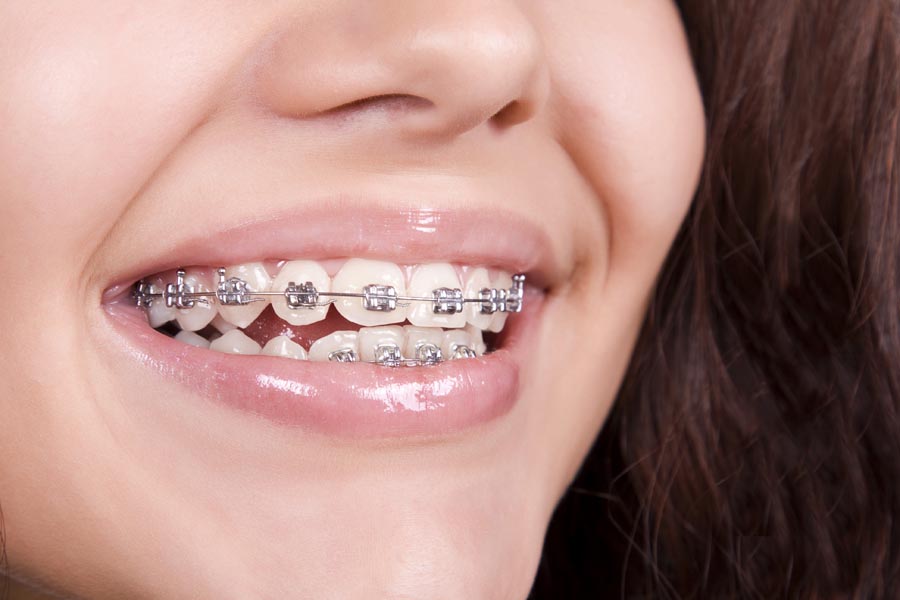 woman smiling with clean braces