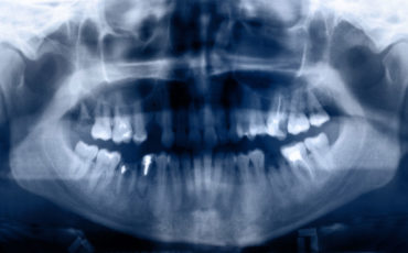 are-orthodontic-xrays-safe