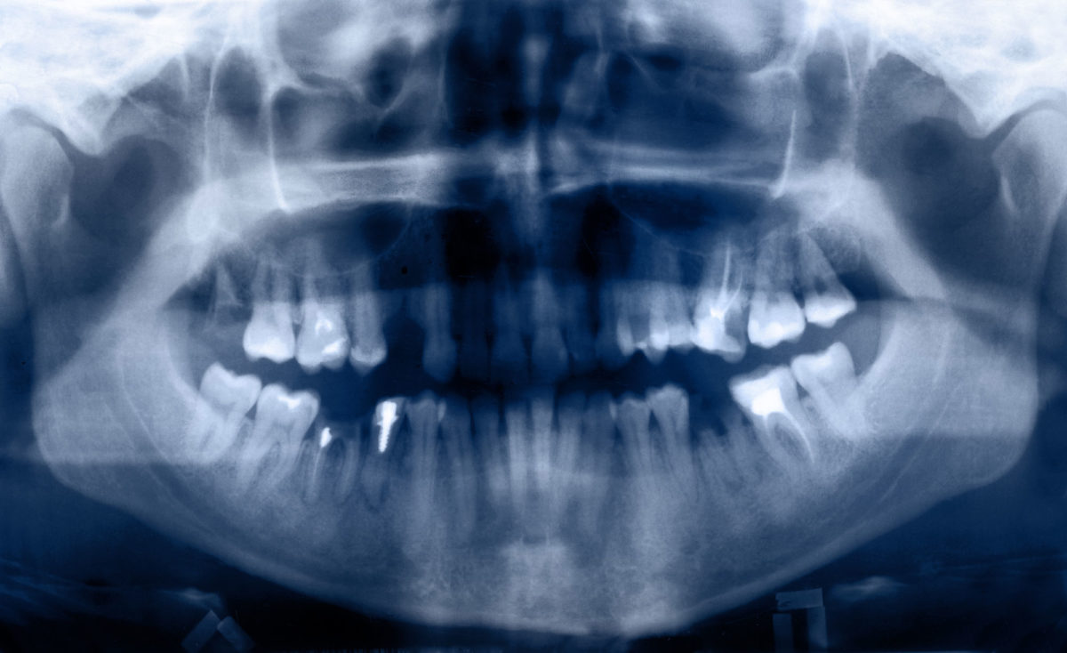 are-orthodontic-xrays-safe