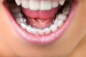 braces-on-my-bottom-teeth