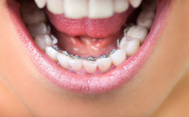 braces-on-my-bottom-teeth