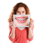 How Braces Work
