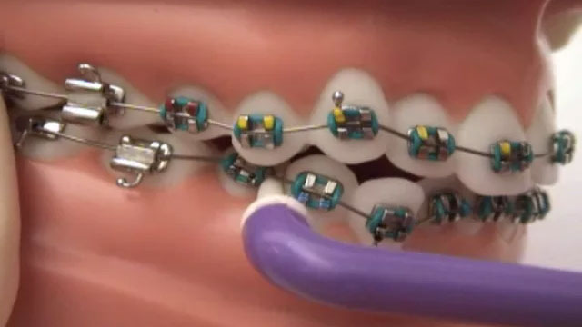 How Braces Work