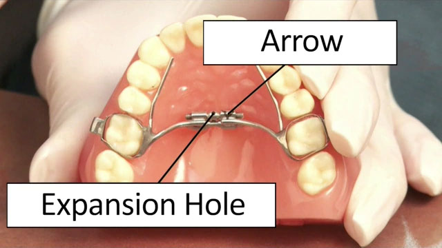 Turning Expander