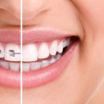 braces-aesthetics