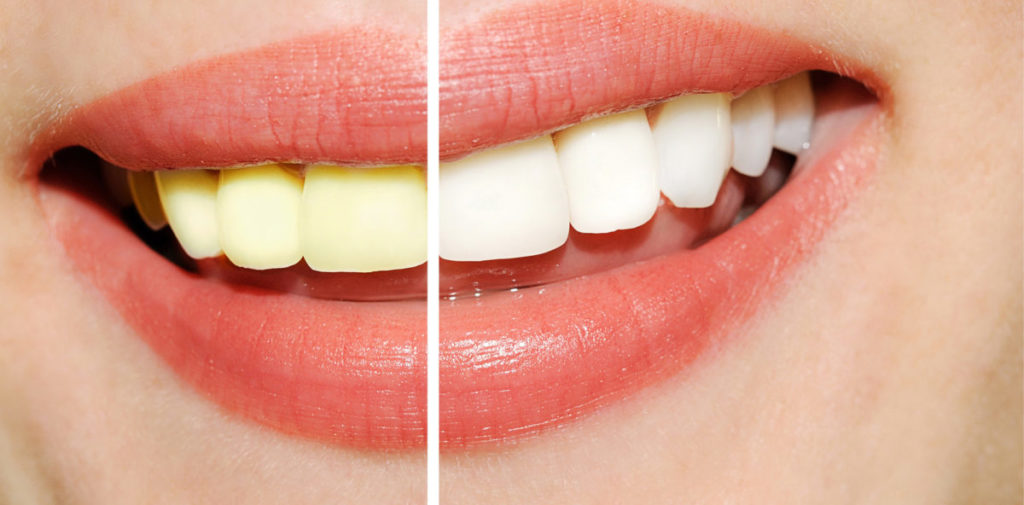 Natural Teeth Whitening Myths That You Should Know About