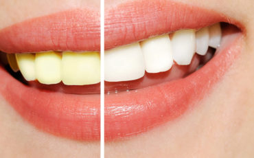 Natural Teeth Whitening Myths That You Should Know About