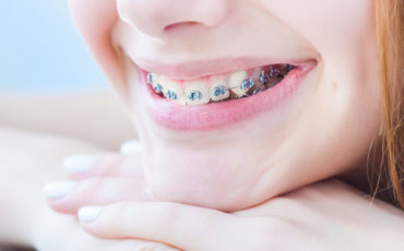 A woman smiling with braces on her teeth.