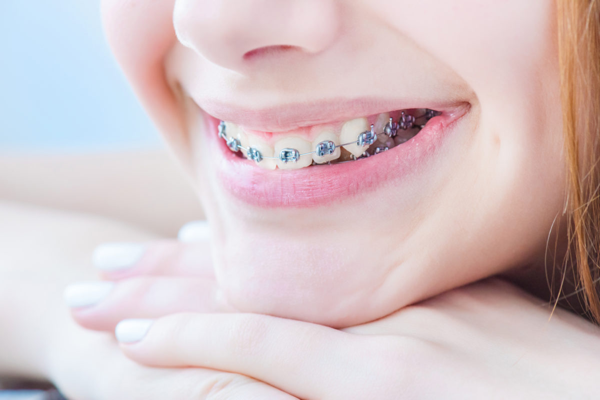 A woman smiling with braces on her teeth.