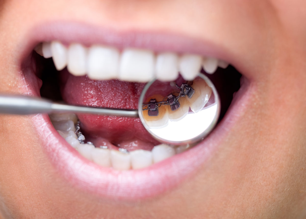 Ask Your New Caney Dentist: Should I Get Metal or Clear Braces?