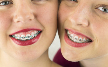 Two girls with braces posing for a photo.
