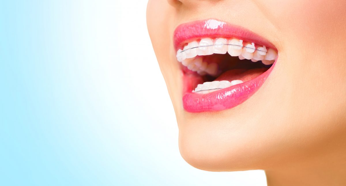 6 Tips for Caring for Ceramic Braces