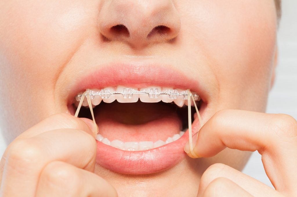 rubber bands for braces