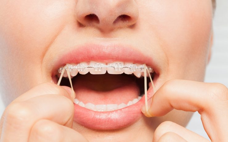 rubber bands for braces