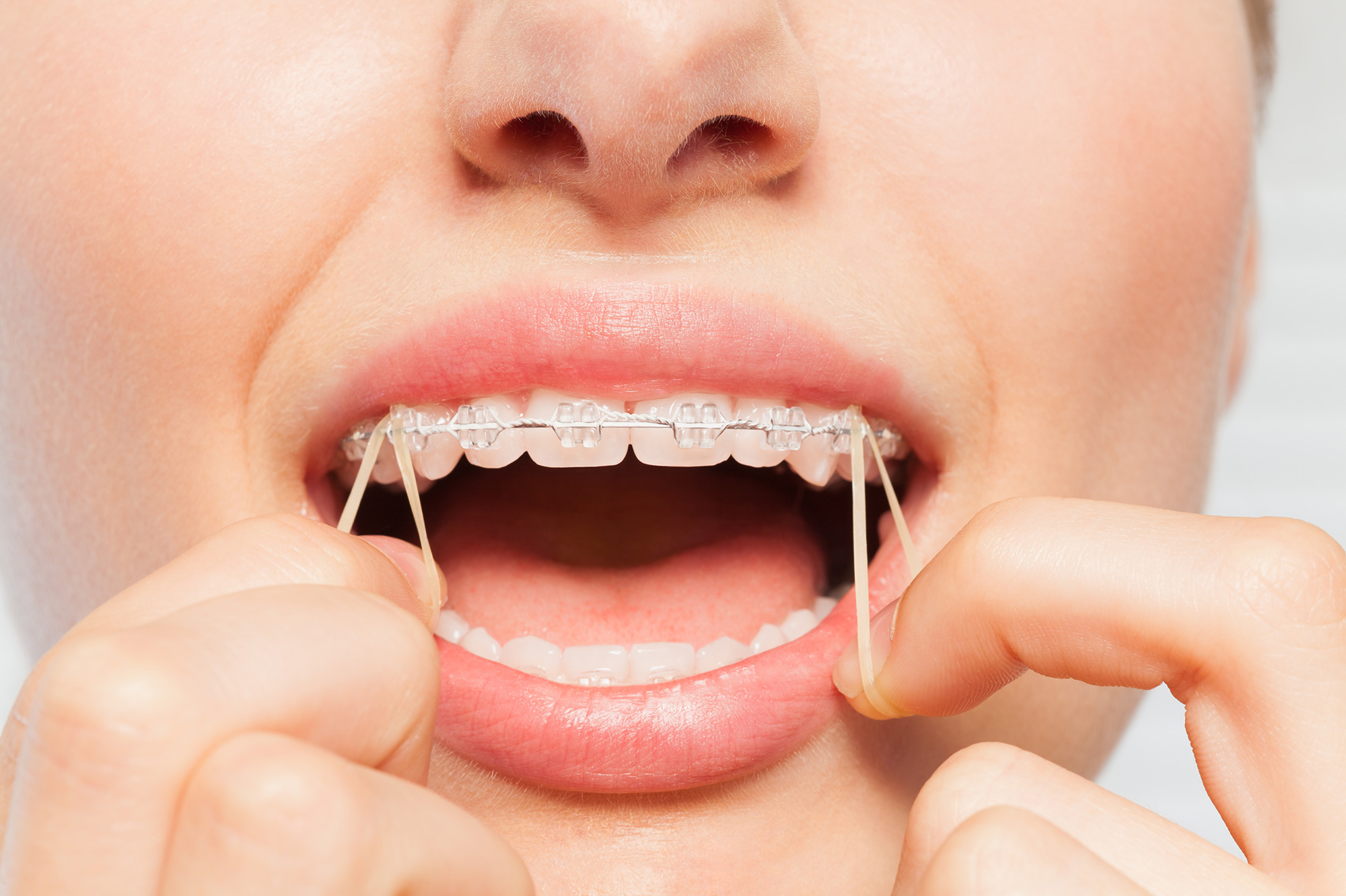 Rubber Bands for Braces Orthodontics