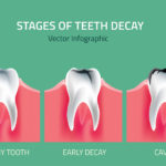tooth decay