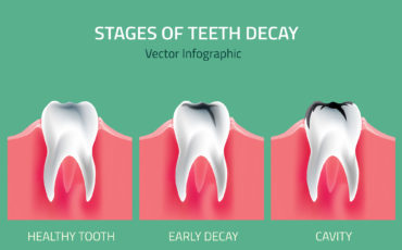 tooth decay